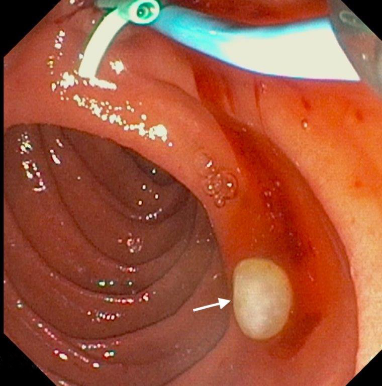 Endoskopieaufnahme des Darms mit sichtbarem Polyp und Instrument